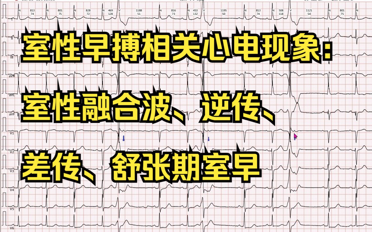 室性早搏相关心电现象室性融合波、逆传、差传、舒张期室早哔哩哔哩bilibili
