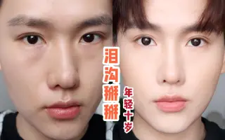 泪沟法令纹鼻基底凹陷 搜索结果 哔哩哔哩 Bilibili