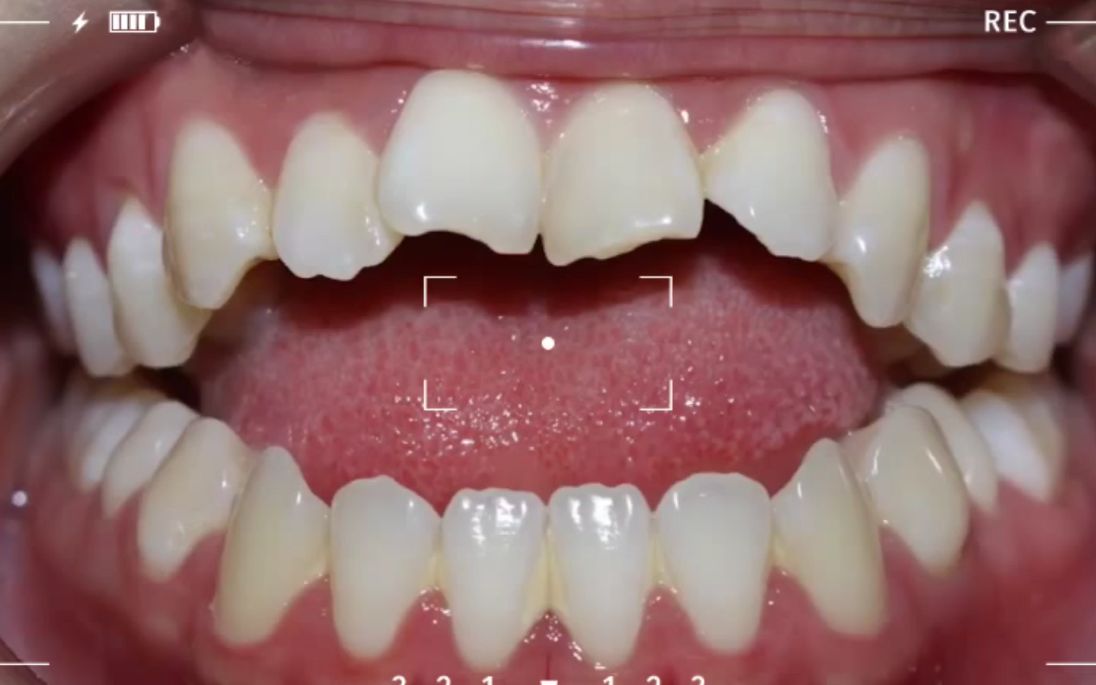 【深圳牙齿矫正】牙齿开颌矫正效果怎样呢?