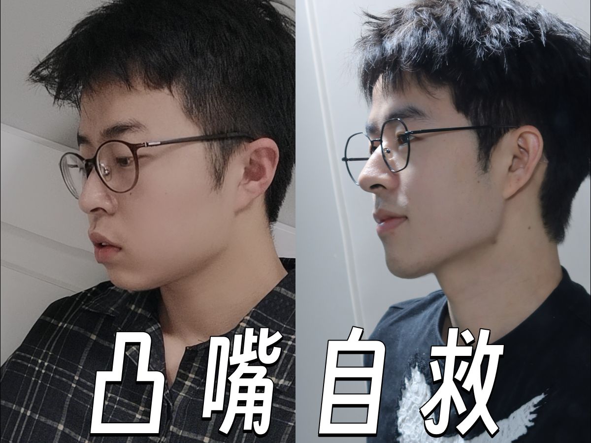 十年凸嘴自救经验分享-2下巴后缩怎么办