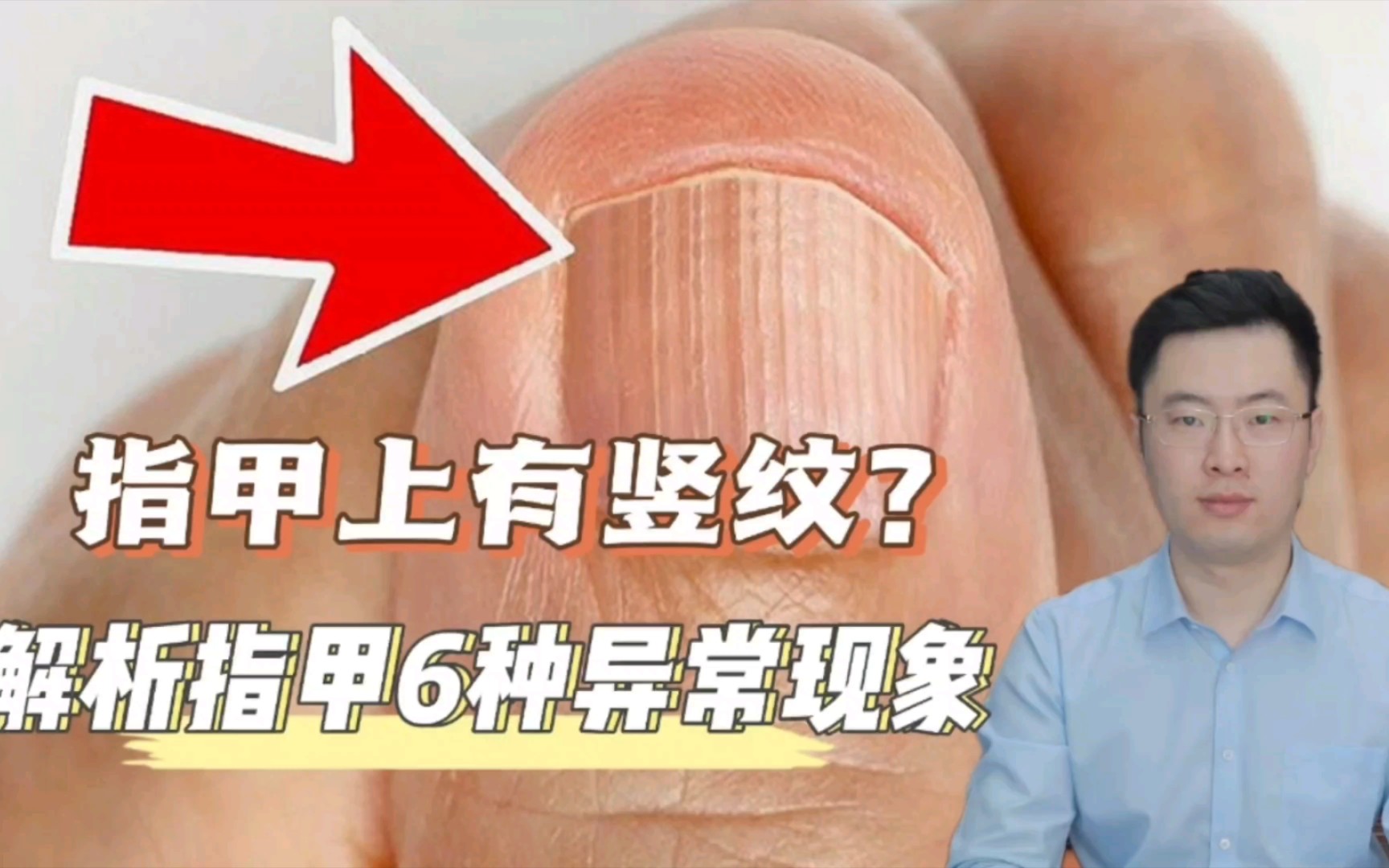 为什么指甲上有竖纹?解析关于指甲的6种常见现象!哔哩哔哩bilibili