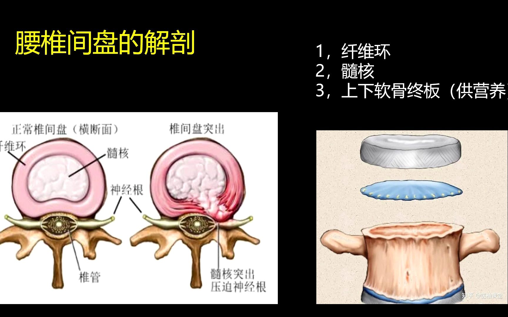 脊柱腰椎间盘突出、腰椎椎管狭窄、腰椎滑脱哔哩哔哩bilibili