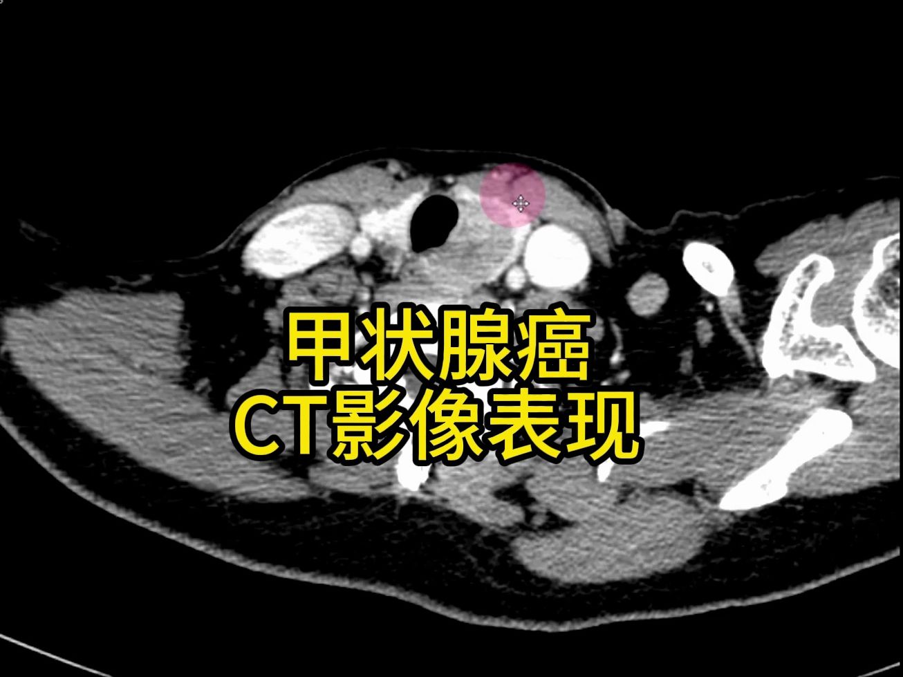 甲状腺癌CT影像表现,甲状腺癌读片技巧哔哩哔哩bilibili