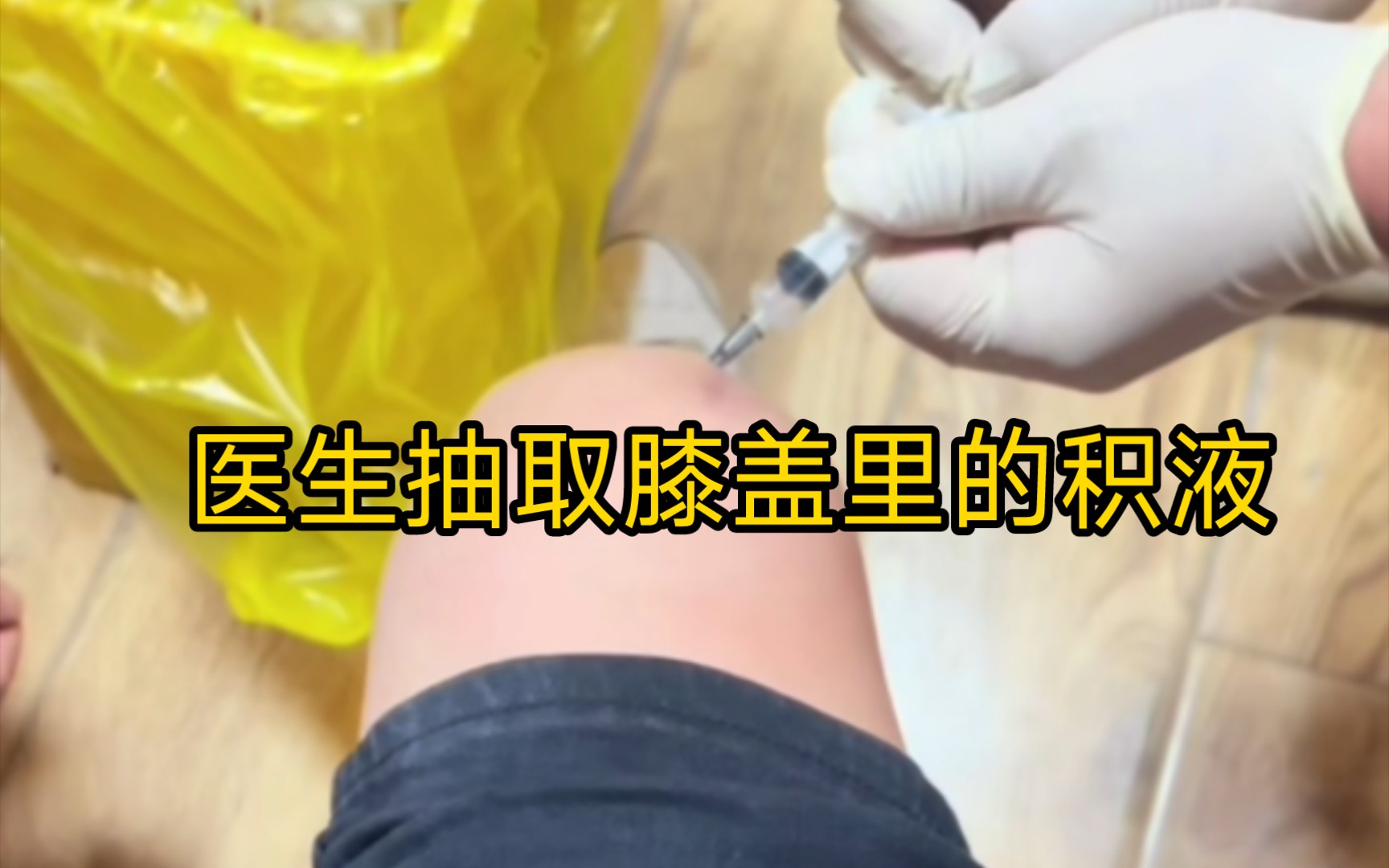 医生竟然抽取膝盖里的积液?这酸爽真的太棒了.
