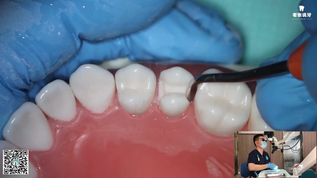 各类嵌体预备实操示教 2-2