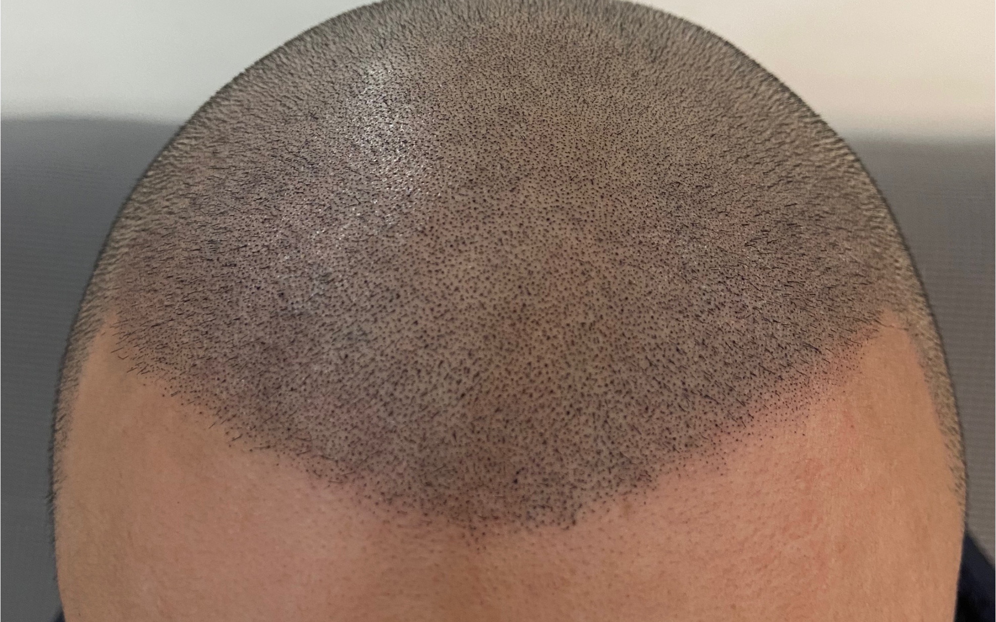 黑龙江哈尔滨星点纹发