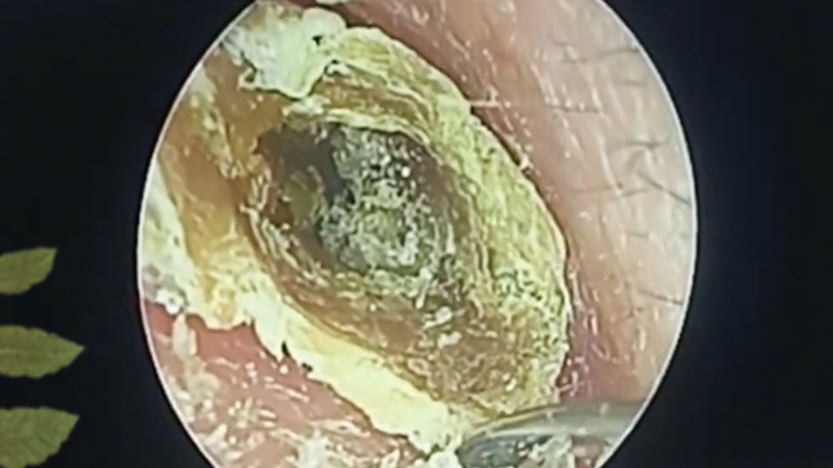 硬邦邦的好大一坨耳屎,把整个耳道堵的严严实实 严重影响听力了