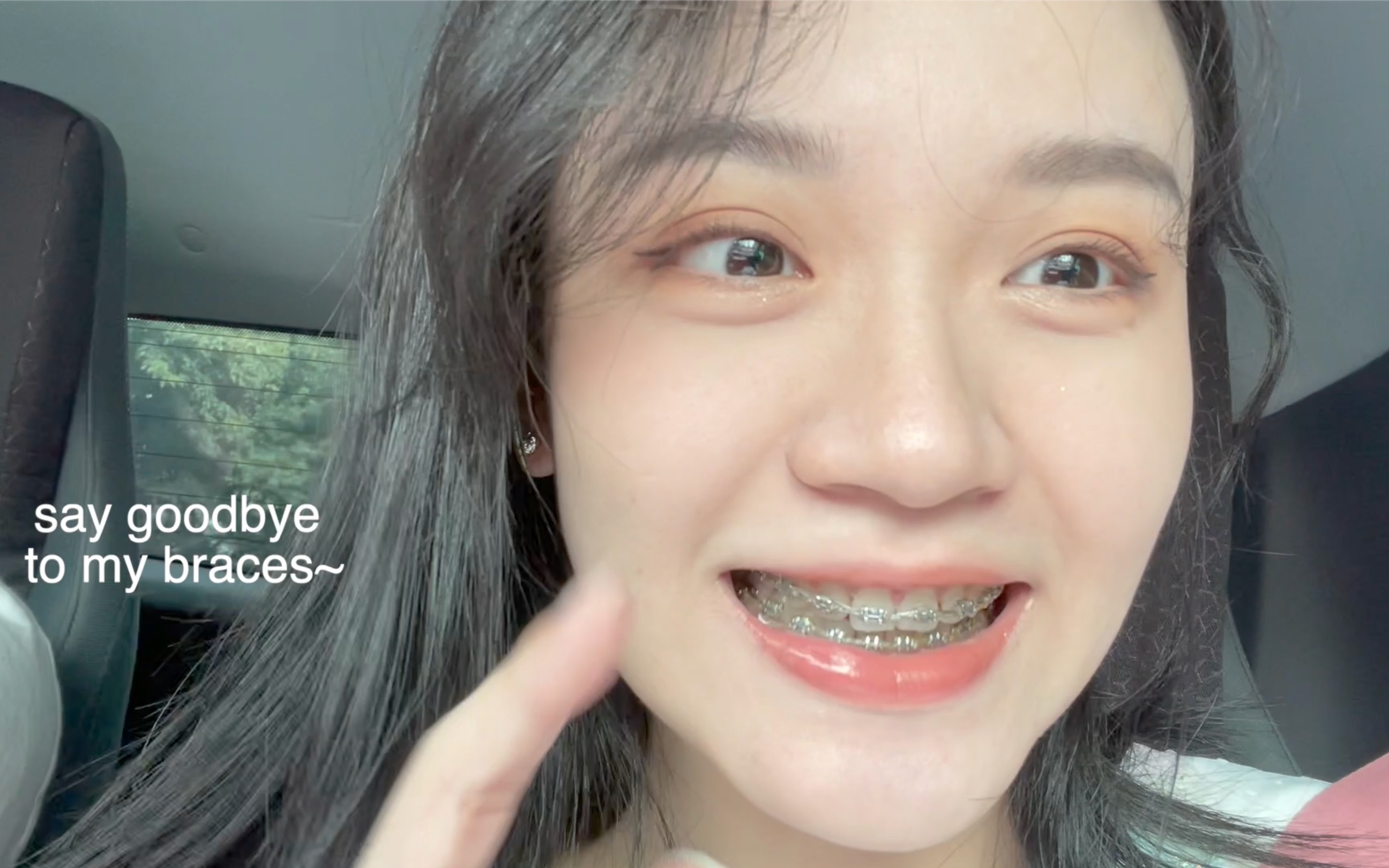 [图]摘牙套vlog｜终于解放的自由人｜Say goodbye to my braces