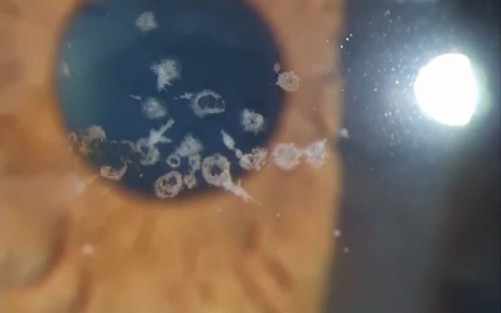 颗粒状角膜营养不良 (Granular Corneal dystrophy type II)哔哩哔哩bilibili