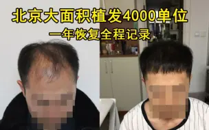 Télécharger la video: 北京大面积植发4000单位，一年恢复全程记录