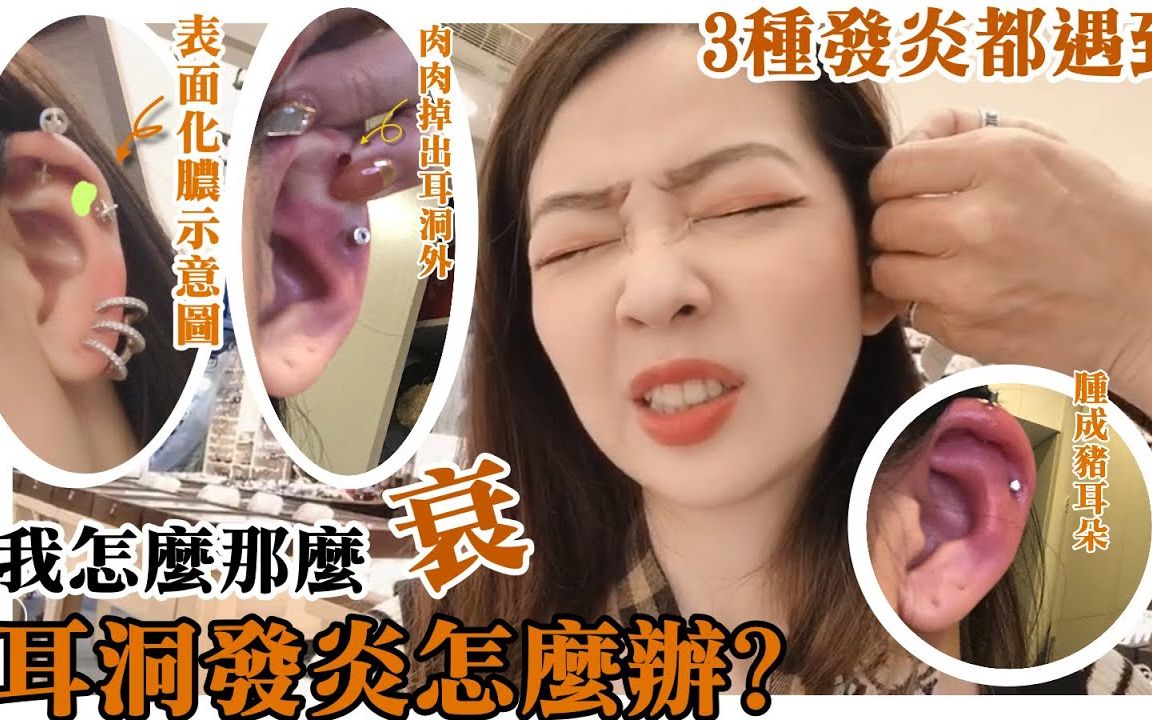 【Kiny's Vlog】耳洞发炎怎麽办耳骨耳洞发炎,肿得像猪耳朵、耳洞红肿、耳洞流脓,kiny教你如何保养耳洞擦药&处理伤口(耳洞发炎全纪录)哔哩哔哩...