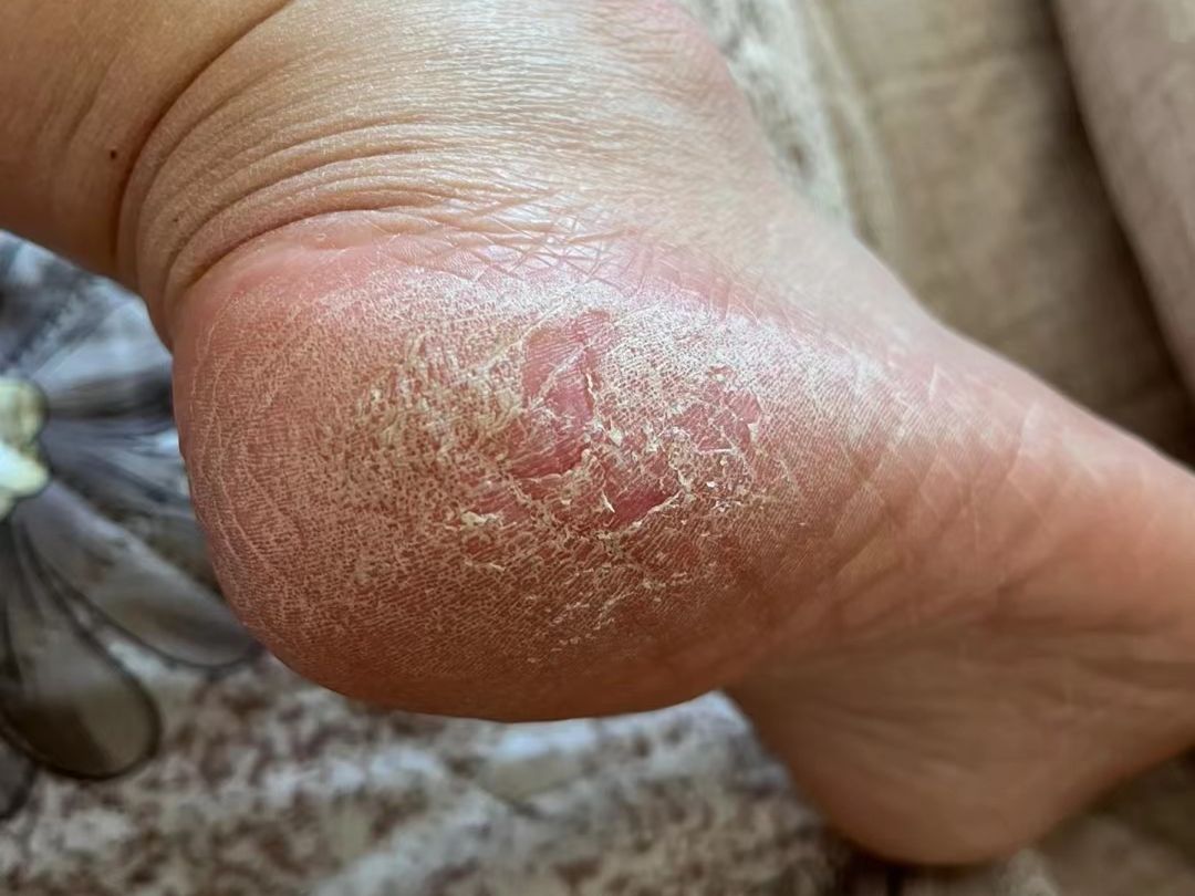 7天解决脚后跟干裂爆皮!不多花一分钱的妙招,你确定不看看?