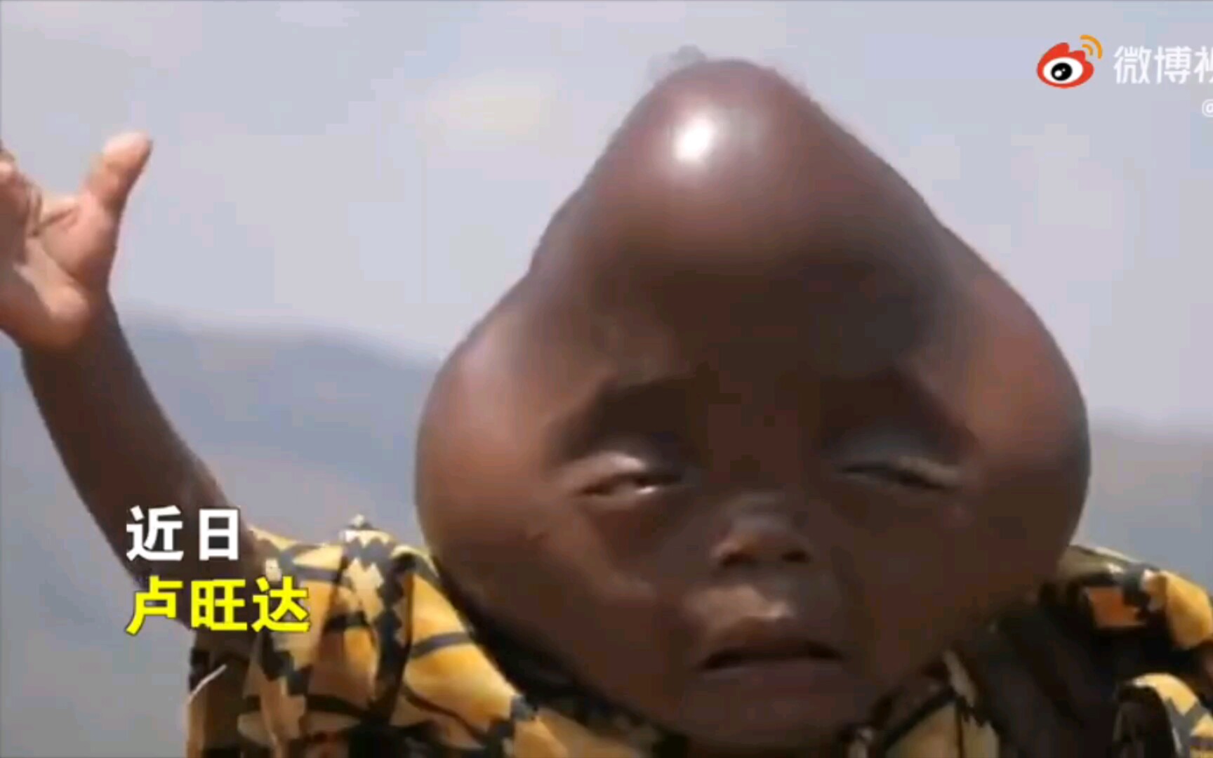 卢旺达一黑人婴儿天生头部呈三角形