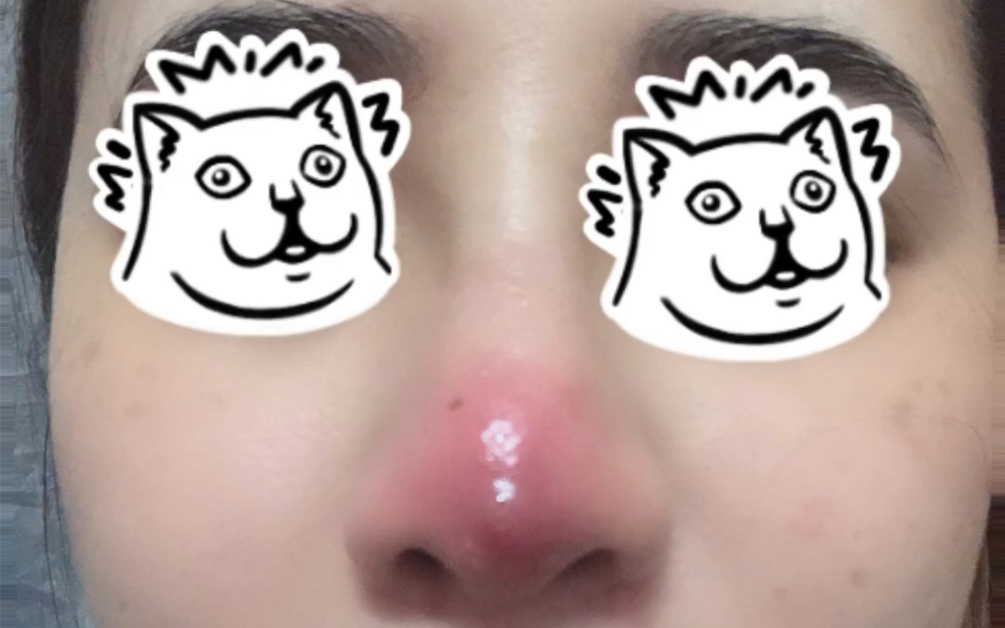 鼻子医美术后感染_哔哩哔哩_bilibili