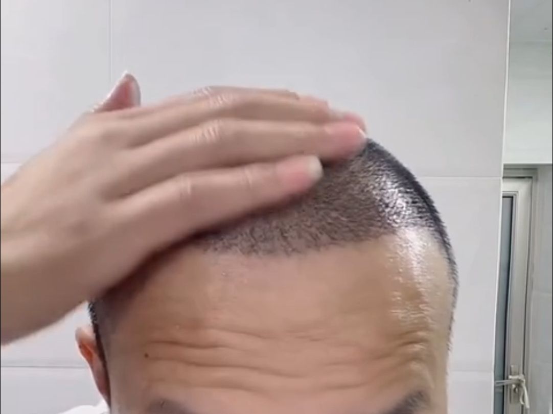 植发怎么不疼(植发疼痛怎么缓解)
