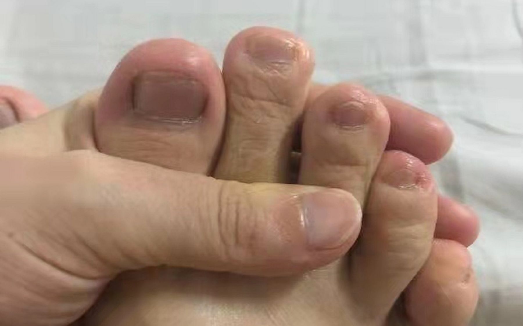 5年灰指甲轻松根除!康复者手把手教学,指甲泛黄增厚的都快点学起来!