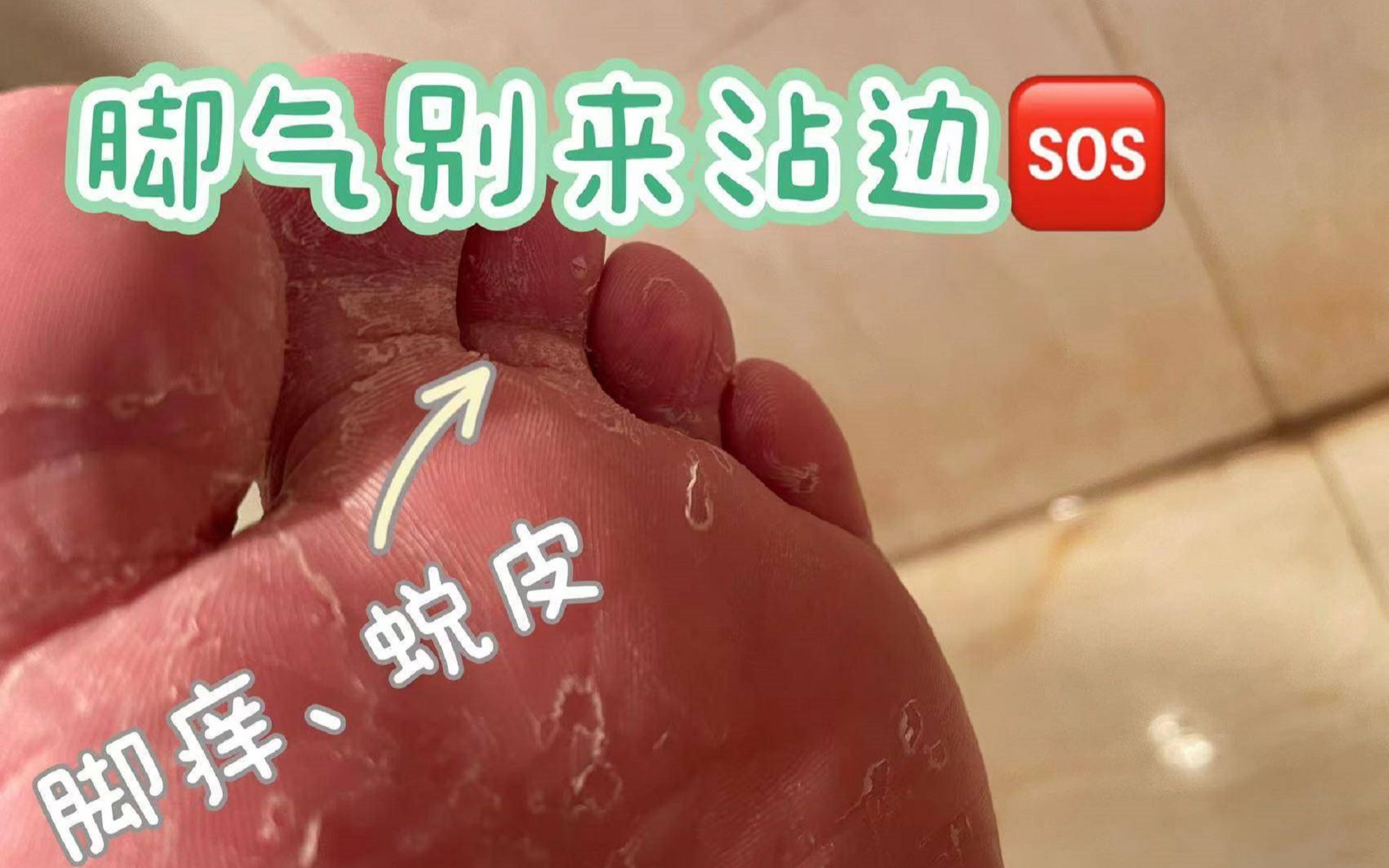 脚气怎么除根?过来人教你一些实用方法,每天几毛钱就能搞定!