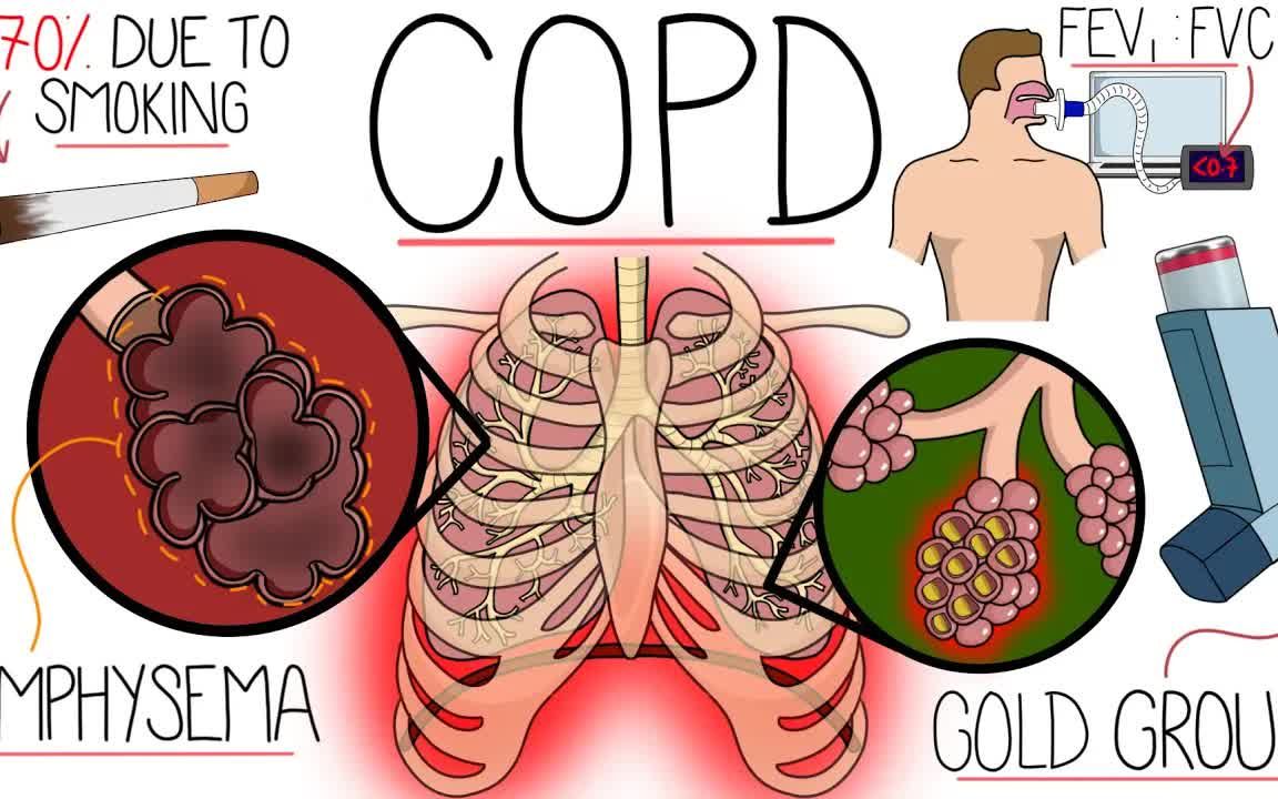 [图]【中英文字幕】了解慢性阻塞性肺疾病（COPD 解释清楚）