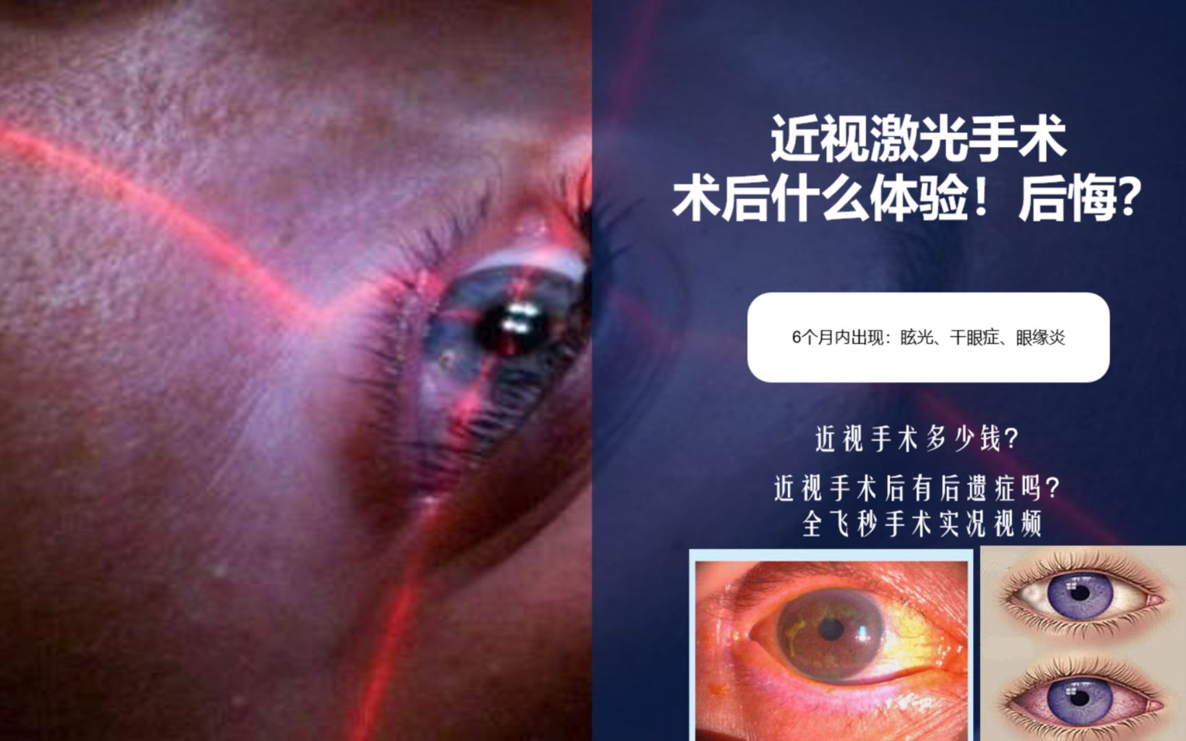 近视手术亲身经历及经验|后遗症!一辈子后悔?全飞秒实况视频