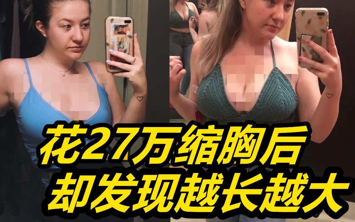 美女嫌自己胸太大,斥巨资做缩胸手术,不料9个月后又长了回来哔哩哔哩bilibili