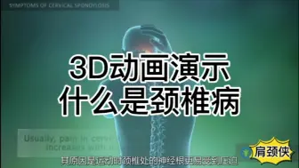 Download Video: 3D动画演示颈椎病#康复理疗##亚健康