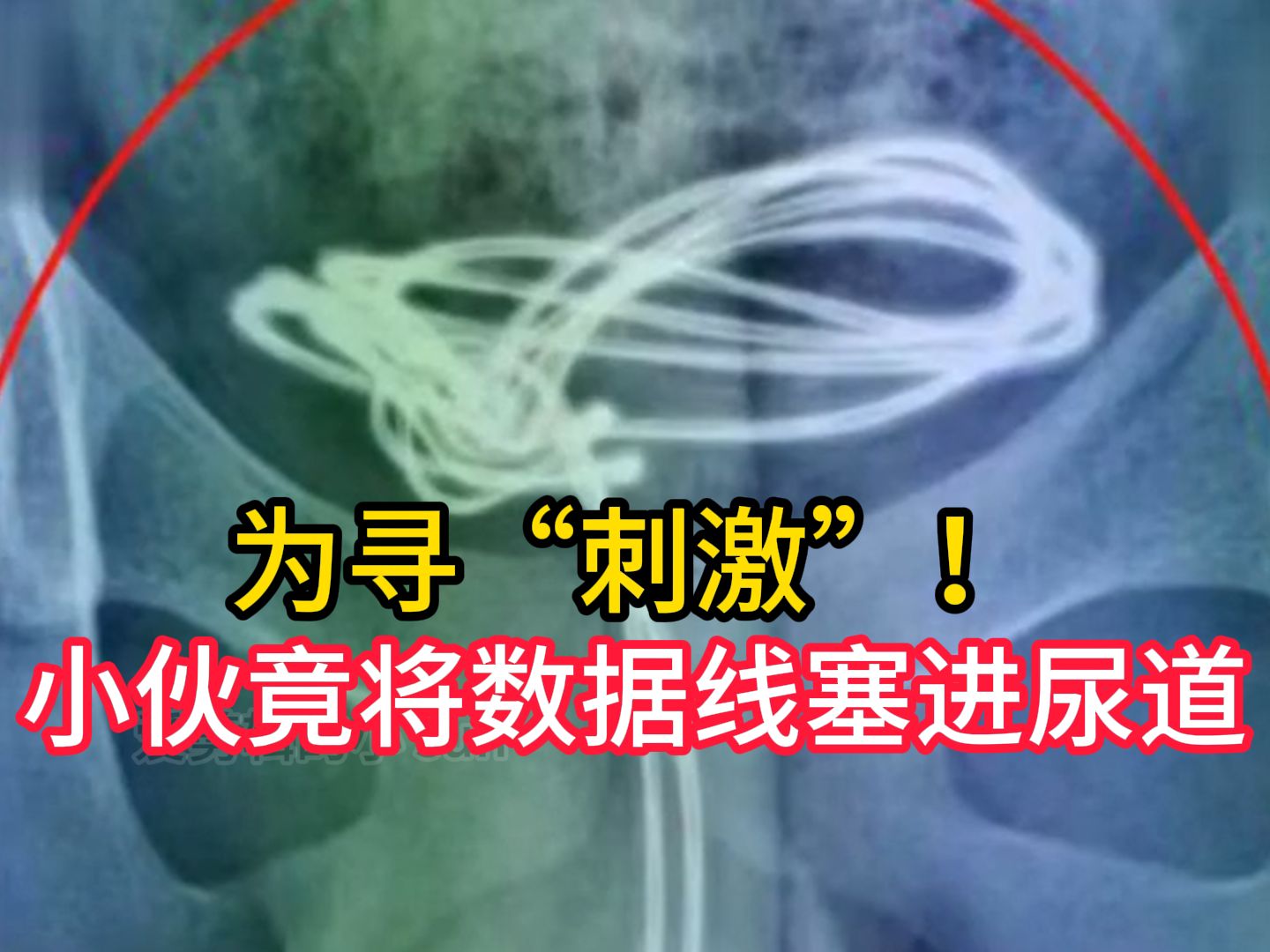 为寻“刺激”!小伙竟将数据线塞进尿道,这下尴尬了哔哩哔哩bilibili