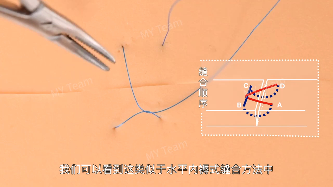 根向复位瓣术图片