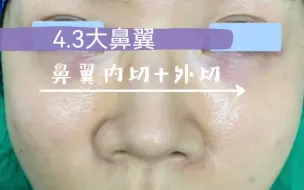 Download Video: 4.3cm大鼻翼缩小后3.5cm，大鼻翼直接变秀气小鼻子。你需要吗？