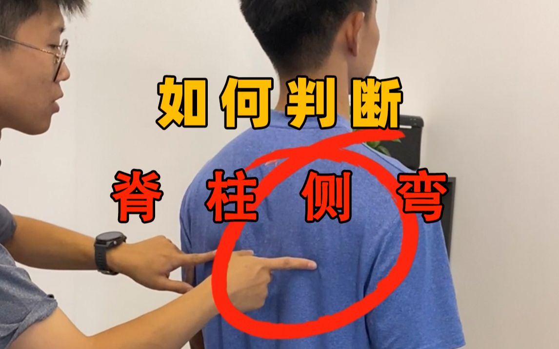如何判断青少年脊柱侧弯?