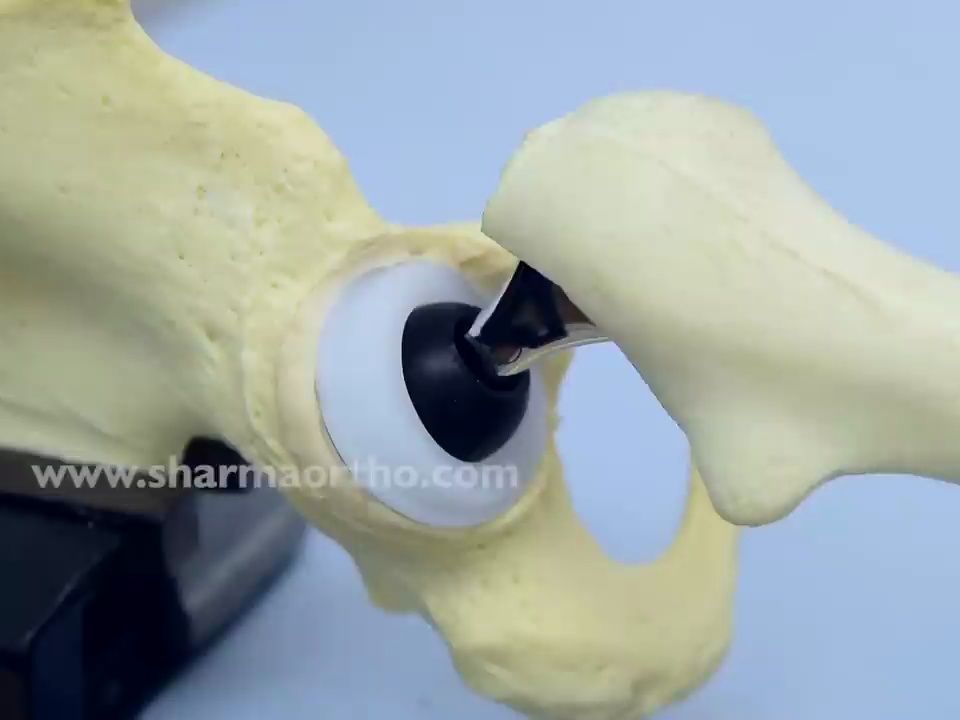 人工髋关节置换模拟——Total Hip Replacement System Cemented哔哩哔哩bilibili