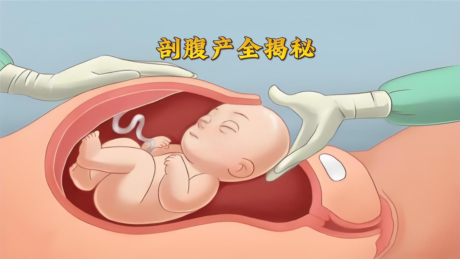 剖腹产大揭秘哔哩哔哩bilibili