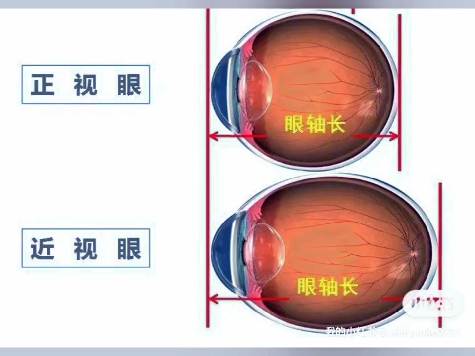 如圖是我們的眼球,近視發生後,眼軸會變長,眼軸每增長1mm,近視度數