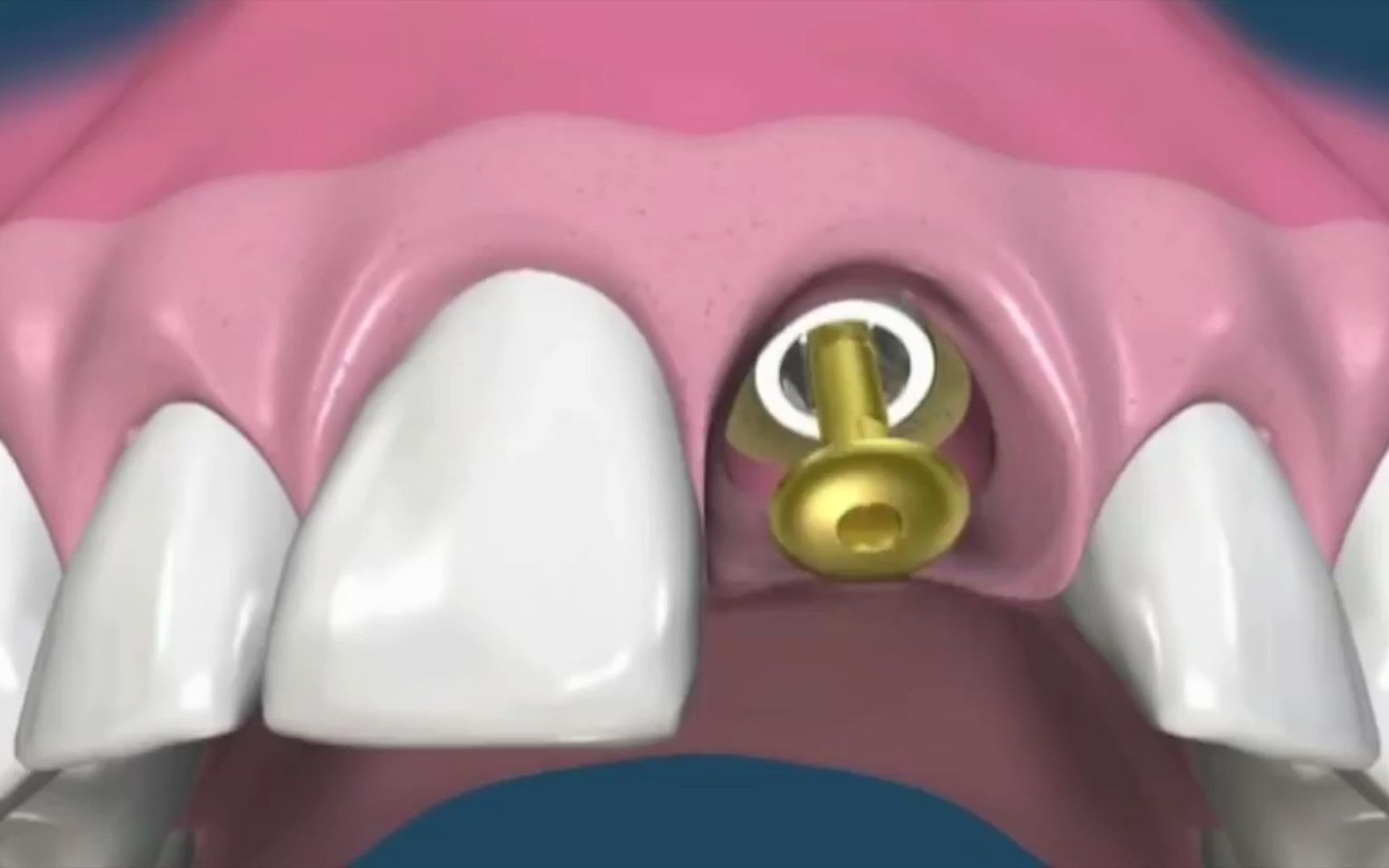 医学3D动画种植牙视频全过程门牙种植哔哩哔哩bilibili