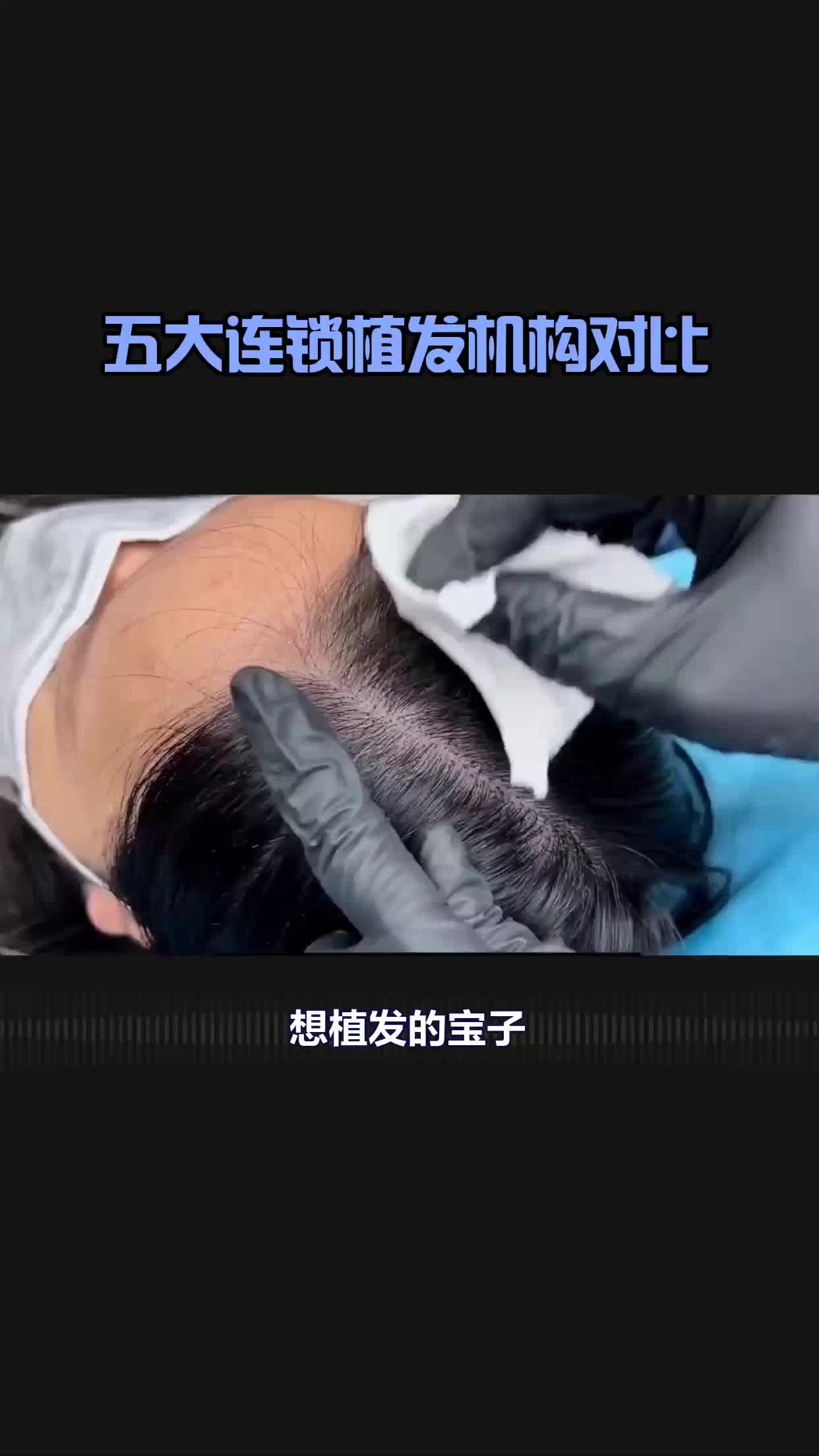 植发要怎么选择(植发怎么选择医院或者机构)