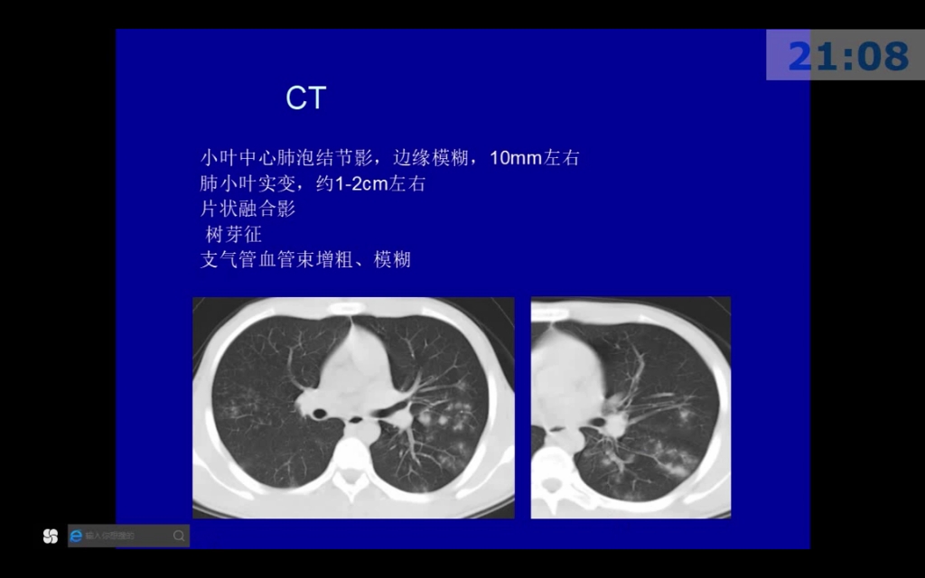 [图]01马大庆:肺炎的影像诊断