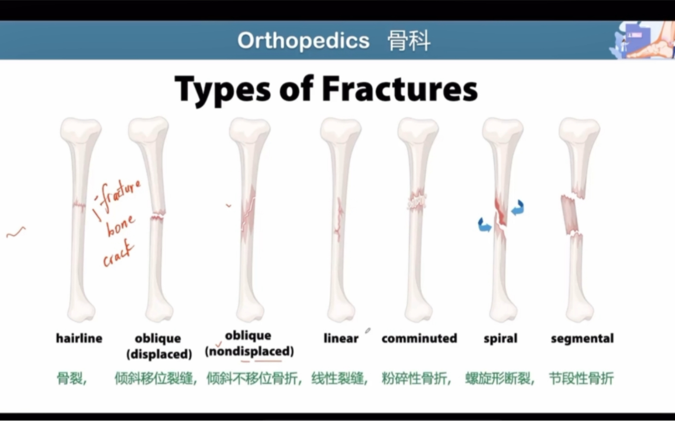 医学英语相关骨科|骨折类型哔哩哔哩bilibili