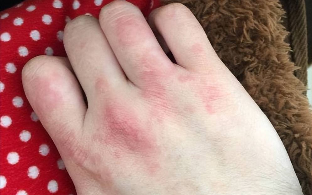 冬天手指红肿刺痒干裂别怕!过来人防治经验分享,3招解决冻疮!