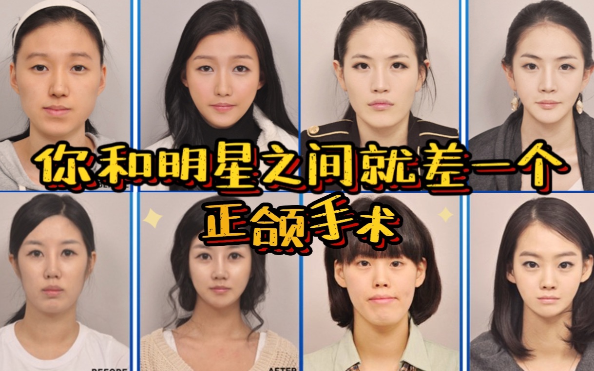 韩国女明星成功换头 你和明星之间就差一个正颌手术