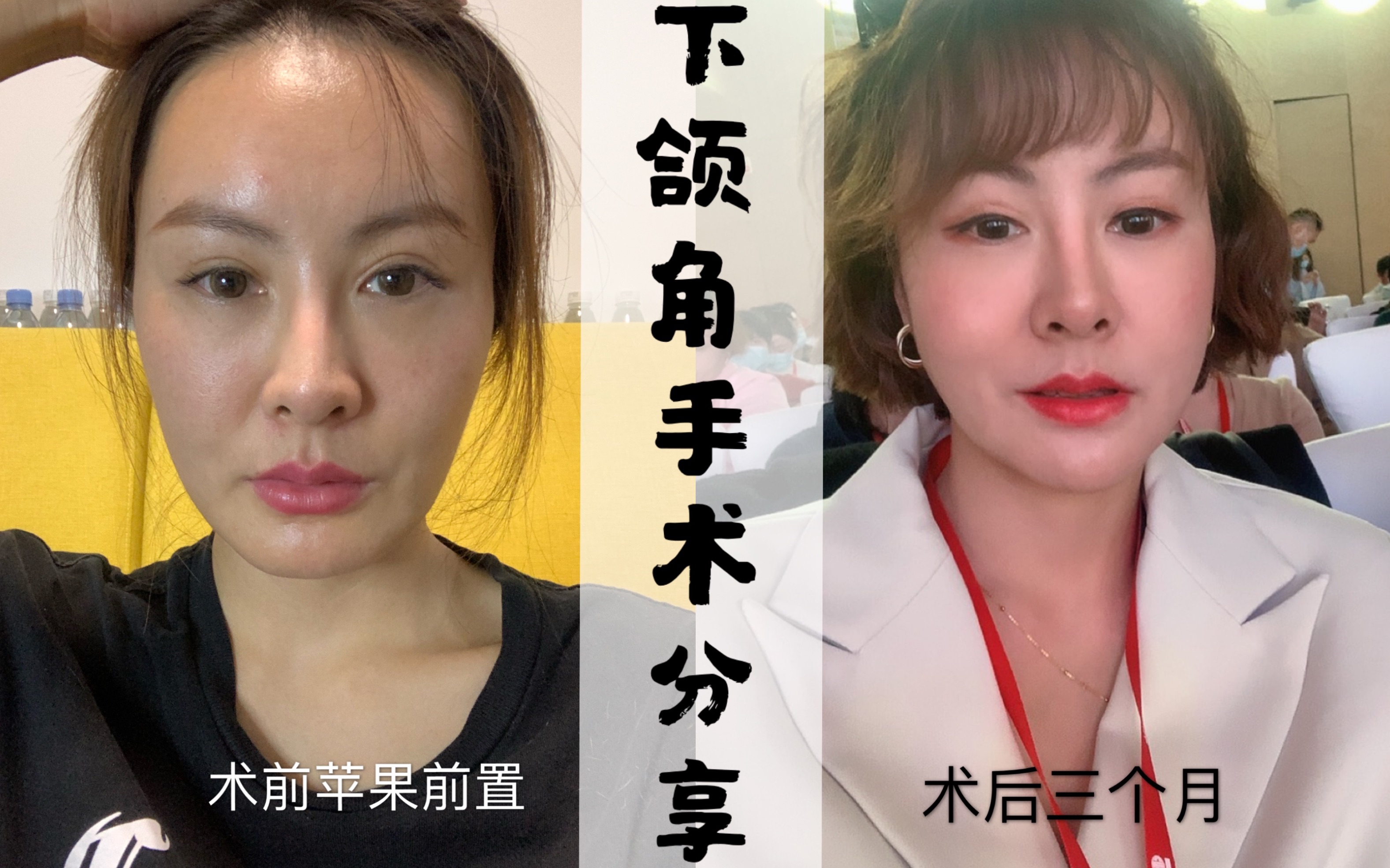 【整形Vlog】轮廓下颌角下巴术后三个月,所有问题汇总,你们关心的都在这里!哔哩哔哩bilibili