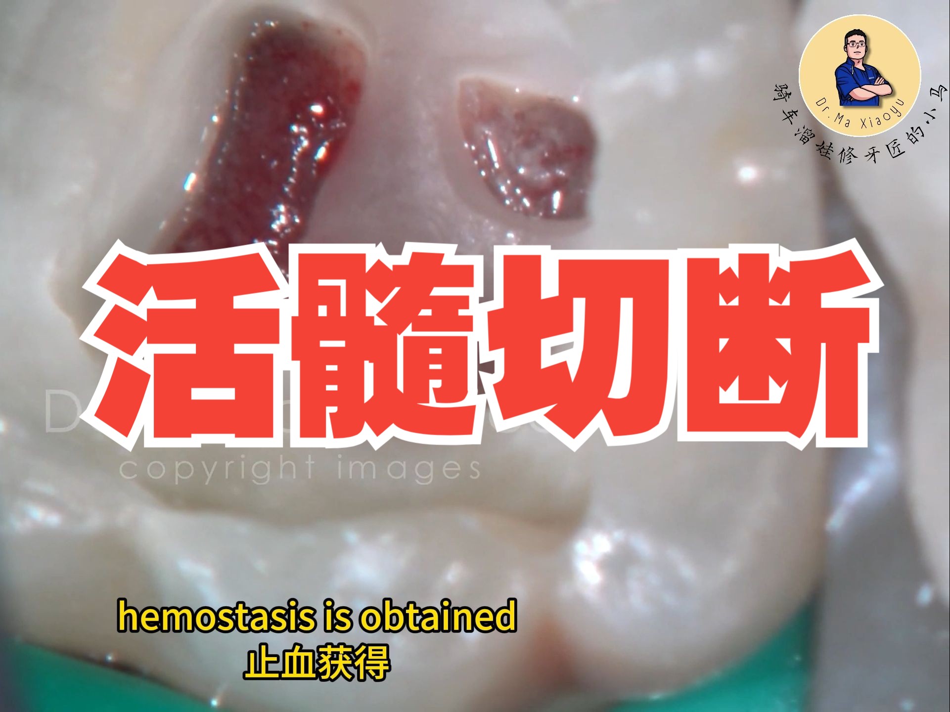 [图]活髓切断 DRendo - Partial pulpotomy procedure using calcium hydroxide