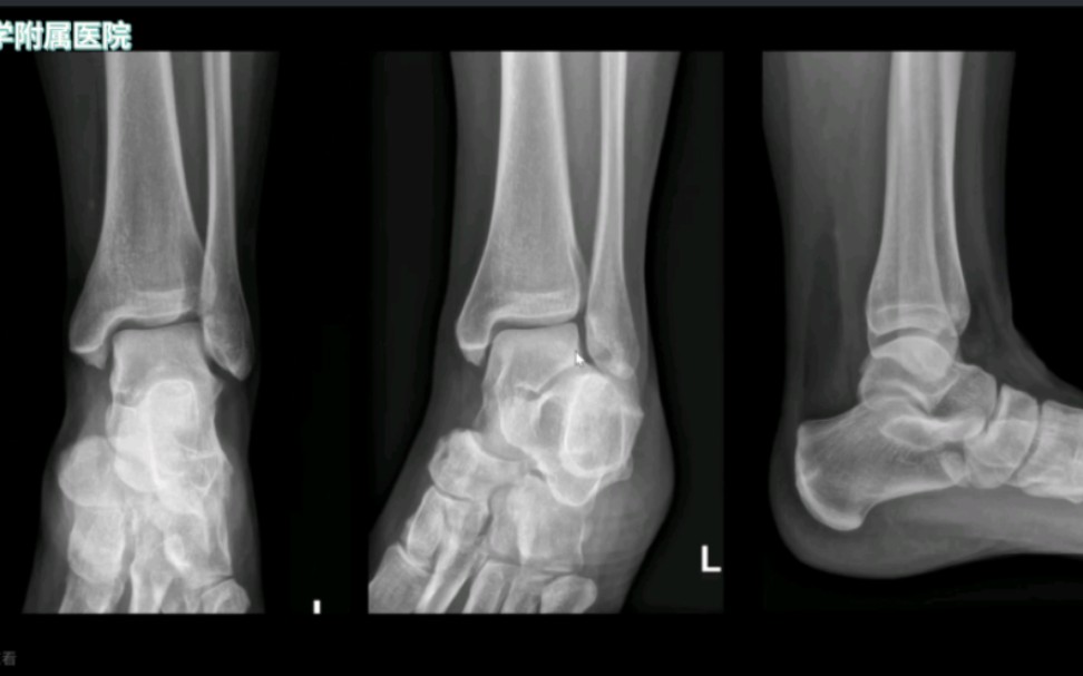 手把手教你读懂“踝关节X线片”哔哩哔哩bilibili