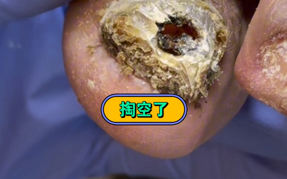 解压视频,甲床里面坏死了,恐怖!