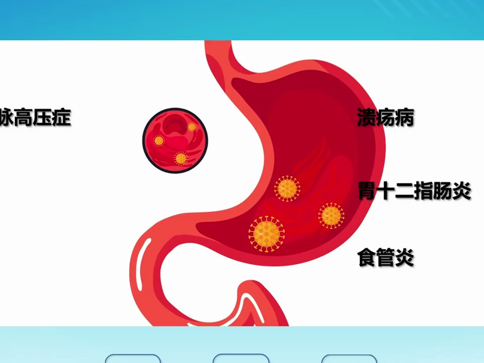 人体消化道出血示意图图片