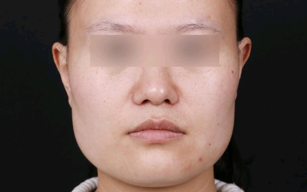 【何照华改脸型】国字脸变美 磨骨3年后