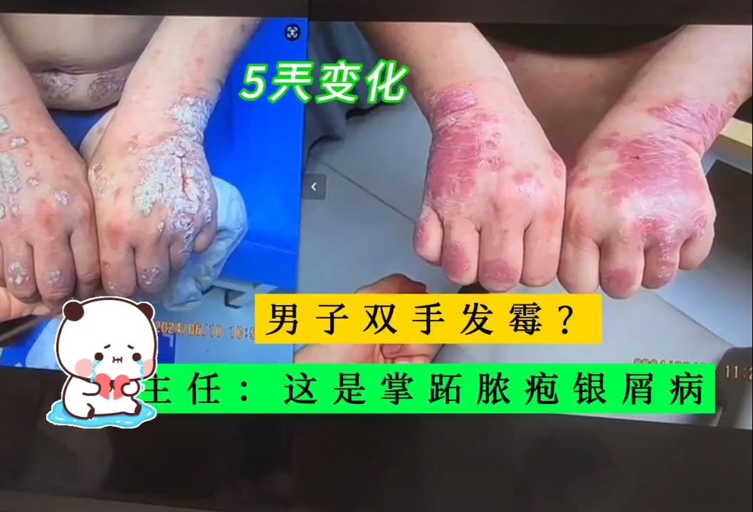 男子双手发霉?5兲变化,主任:这是掌跖脓疱银屑病