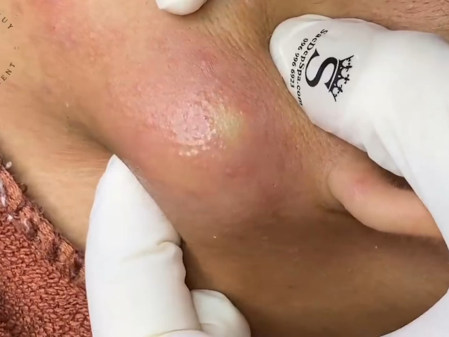 脓包比肿瘤还大是被马蜂蛰了吧全是大货