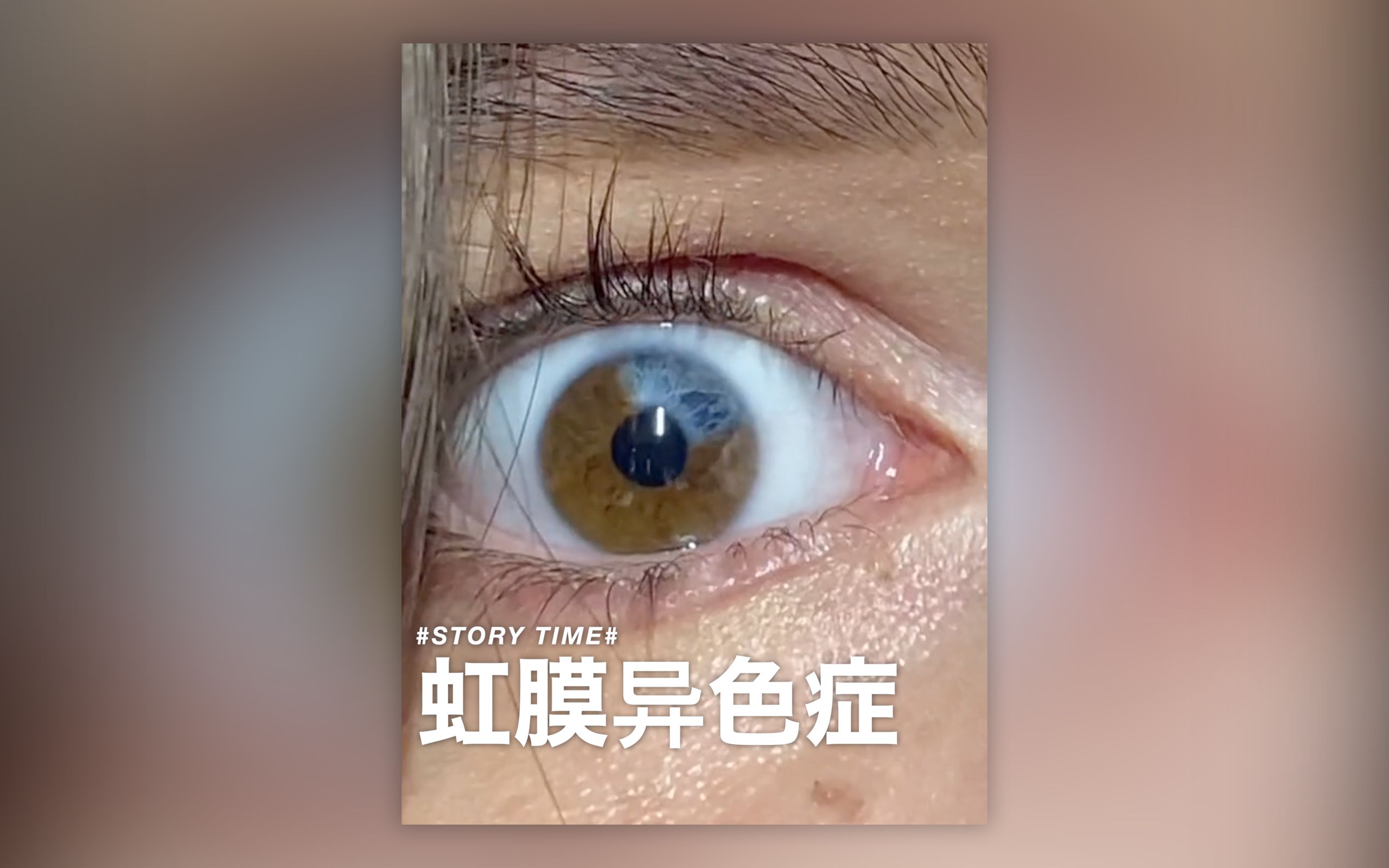 [图]【虹膜异色症】“我从小因为我的眼睛而被欺负多年...”