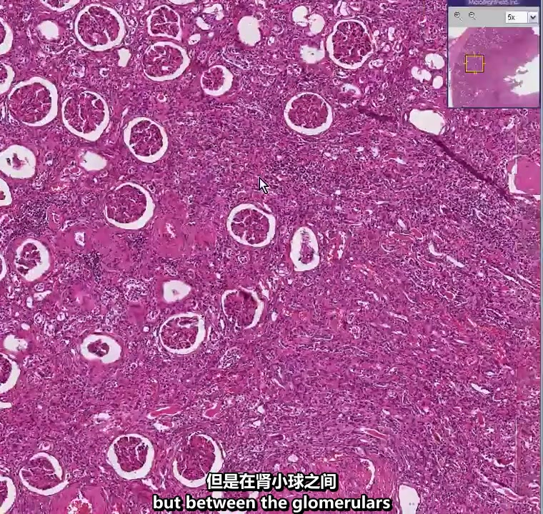 肾病理切片急性和慢性肾盂肾炎histopathologykidneyacuteandchronic