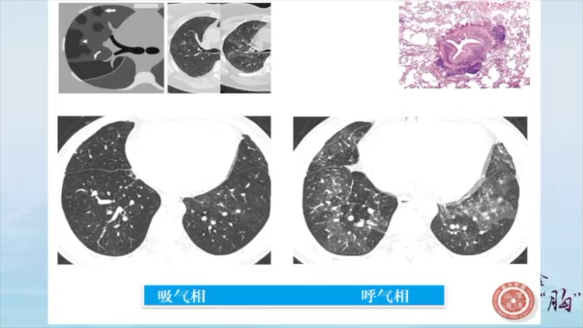 [图]2021全国弥漫性肺病-临床影像与病理诊断学习班：03气道病变的影像学概论--高莉