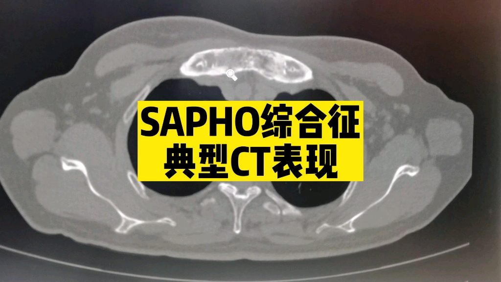 【罕见病例】反复前胸肿痛,发现胸骨异常,一定警惕SAPHO综合征 医学影像 | 放射科 | 医学生哔哩哔哩bilibili